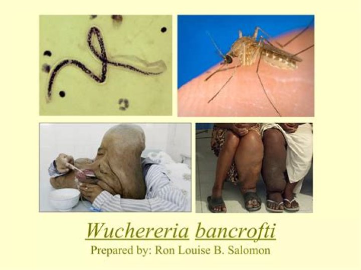 Which disease is caused by Wuchereria bancrofti?