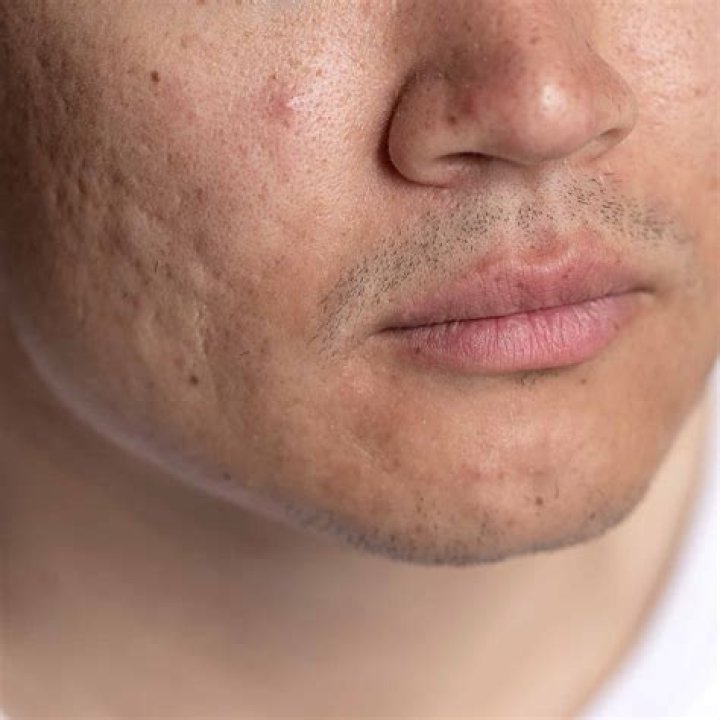 Which facial treatment is best for acne scars?