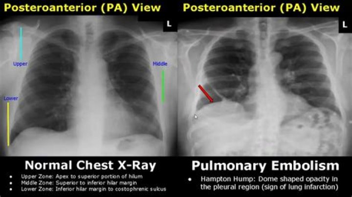 Which is better CT scan or X-ray for lungs?