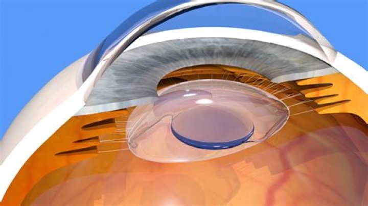 Which is the best IOL lens for cataract surgery?
