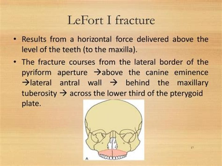 Which LeFort fracture is the most common?