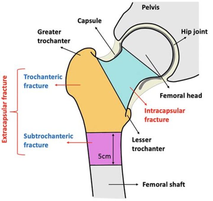 Which treatment is better when proximal femur fractures?