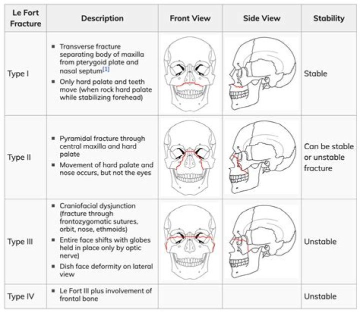 Which type of Le Fort fracture is most commonly associated with leaking of CSF?