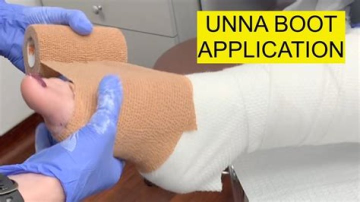 Who applies Unna Boot?