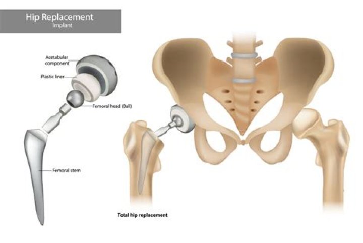 Who does anterior hip replacement in Toronto?
