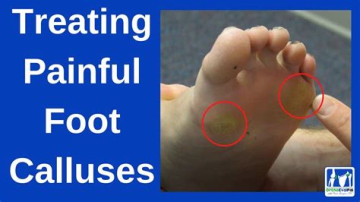 Why are the balls of my feet calloused?