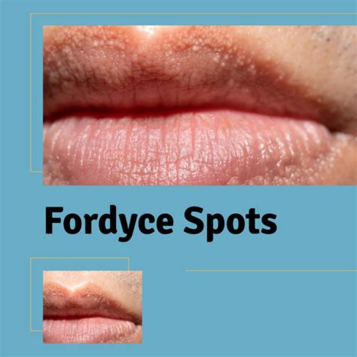 Why did I suddenly get Fordyce spots?