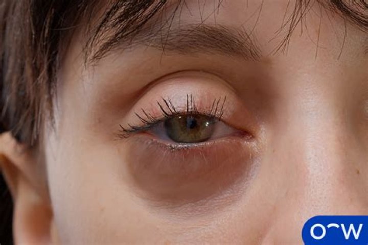 Why do my eyes make sound?