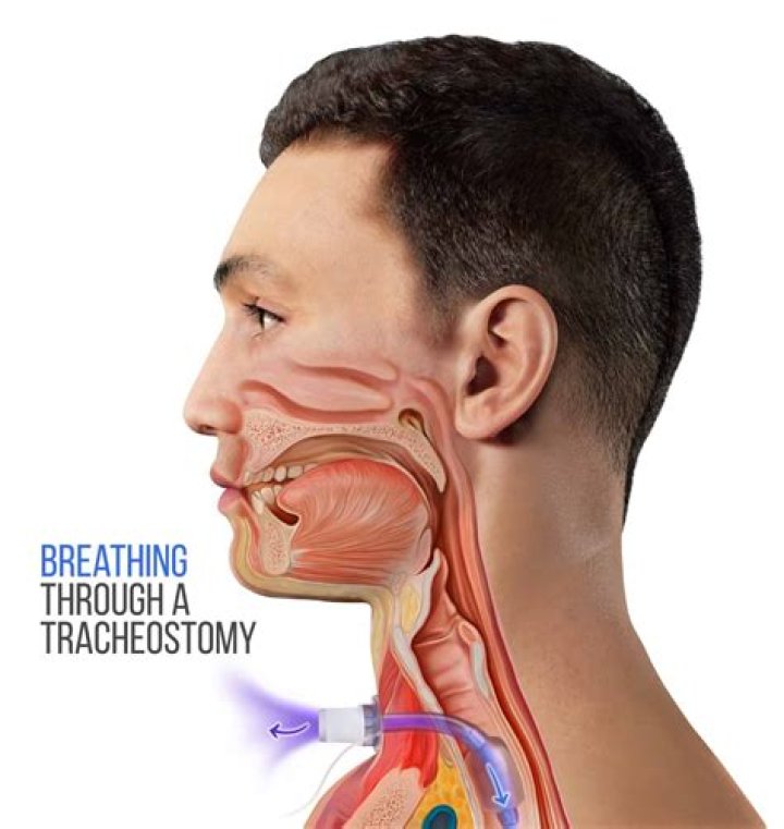 Why do they put a trach in your throat?