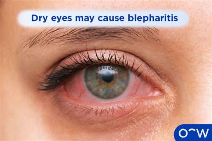 Why does blepharitis cause red eyes?