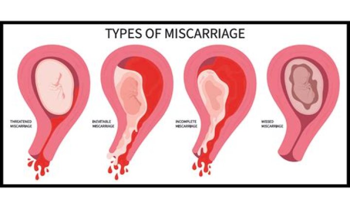 Why does lupus anticoagulant cause miscarriage?