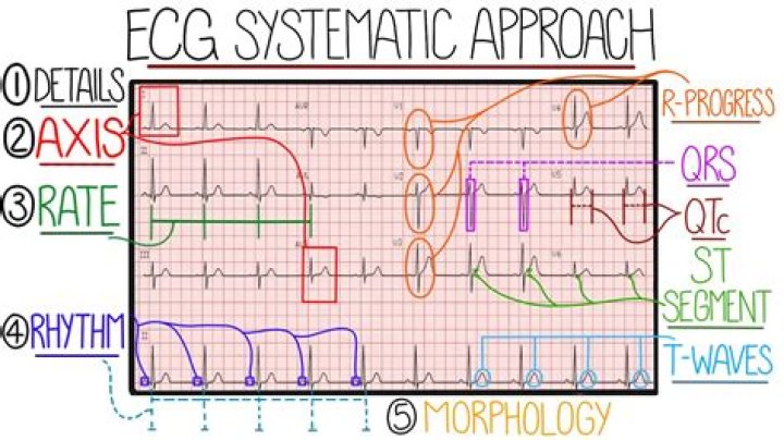Why is a systematic approach useful when interpreting EKG?