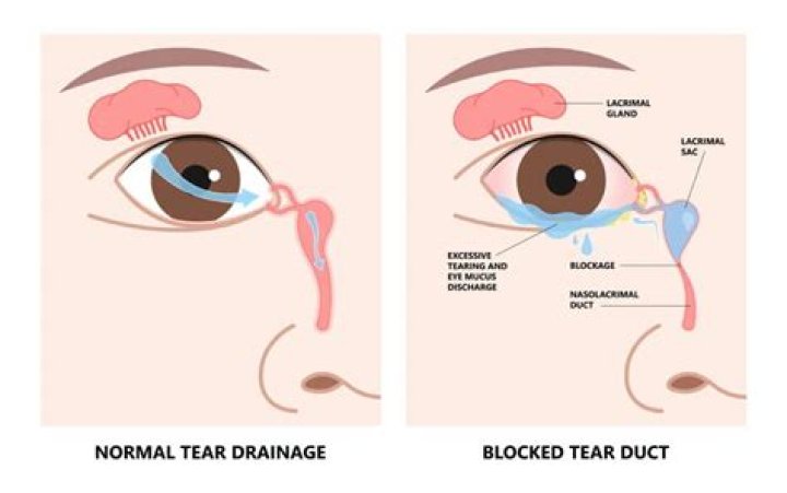 Why is one nostril clogged but the other isn t?