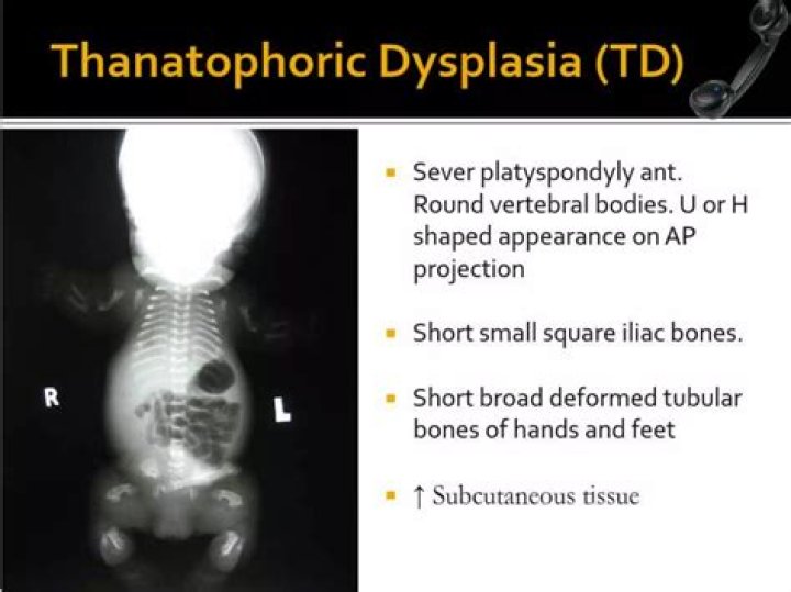 Why is Thanatophoric dysplasia lethal?