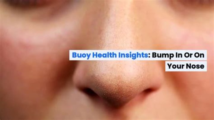 Why is there a hard lump inside my nose?